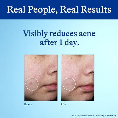 Differin 10% Benzoyl Peroxide Acne Spot Treatment - Imperfect Box - Image 6