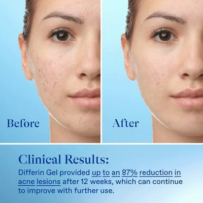 Differin Retinoid Acne Treatment Adapalene Gel 0.1% 45g - Image 7